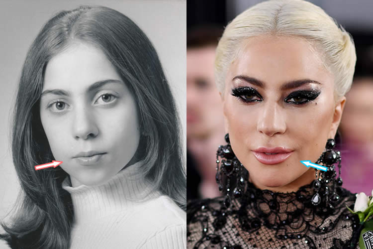 Did Lady Gaga Seek Help From Plastic Surgeons Plasticsurgerypro Info.
