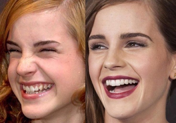 Emma Watson Surgery