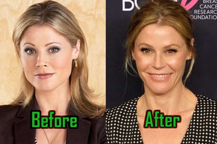 How old was julie bowen when she had plastic surgery? 