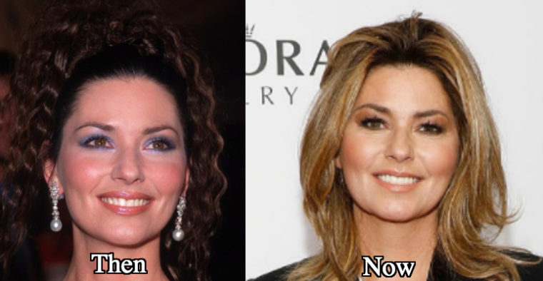 Why does Shania Twain Look So Puffy? 