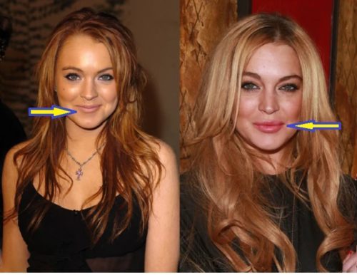 lindsay lohan plastic surgery before and after