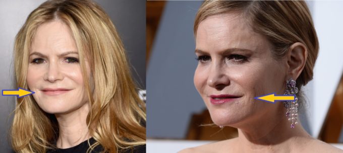 Jennifer Jason Leigh Plastic Surgery Before And After Face Lift Botox Plasticsurgerypro Info